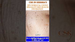 CSK Dermatosis papulosa nigra tamil  DPN tamil  CSK DPN centre [upl. by Oskar]