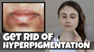 GET RID OF HYPERPIGMENTATION AROUND THE MOUTH DR DRAY [upl. by Akcinahs]