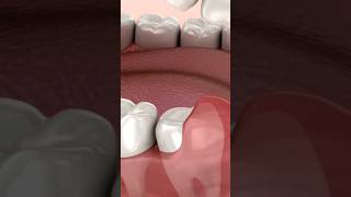 quotPericoronitis amp Wisdom Teeth Pain Causes Explained  DentalHealth365quotshorts viralvideo short [upl. by Deevan]