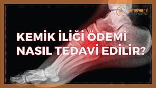 KEMİK İLİĞİ ÖDEMİ NASIL TEDAVİ EDİLİR [upl. by Roper]