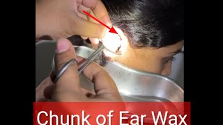 Chunk of earwax removed by aural syringing😯😯aural syringingremoval of earwax [upl. by Monreal]