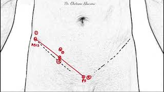 Surface marking of inguinal canal and its clinical correlations [upl. by Ellienad]