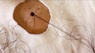 Removal of ingrown hair Eliminación de pelo encarnado [upl. by Aldwon52]