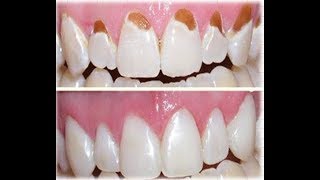 Tooth enamel loss amp How to repair tooth enamel [upl. by Nnaael575]