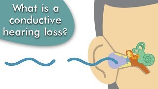 Conductive Hearing Loss Explained [upl. by Mirak]