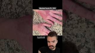 Margarita dermatitis is caused by WHAT morbidfacts [upl. by Ramunni]