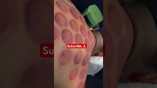 Sports massage cuppingtherapy shorts asmrsounds [upl. by Spracklen]