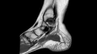 Ankle MRI anatomy [upl. by Artened]