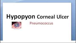 Ophthalmology 112 b Hypopyon Corneal Ulcer Strepcococcus pneumoniae Pneumococcus ulcus serpens [upl. by Aidne]