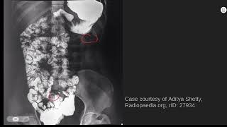 Midgut malrotation radiology abr core [upl. by Haroun]