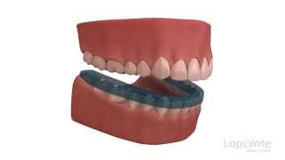 Abfraction and abrasion  Lapointe dental centres [upl. by Adoree]