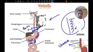 Esophageal cancer [upl. by Eiramanig827]