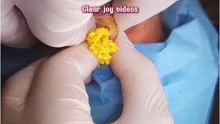 Big Cystic Acne Blackheads Extraction Blackheads amp Milia Whiteheads Removal Pimple Popping [upl. by Laenaj]