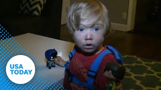 Toddler suffers from rare vampirelike symptoms [upl. by Eldwon859]