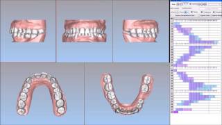 Setup allineamento dentale  Dentaurum Italia Digital [upl. by Nonnelg]