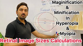 Smaller image in hyperopia and larger image in myopia [upl. by Sharla550]