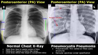 Chest XRay Lung Normal Vs Abnormal Image Appearances Part 1  TBPneumoniaConsolidationCollapse [upl. by Nidia518]