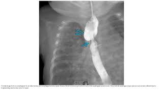 Esophageal Strictures [upl. by Barnum]