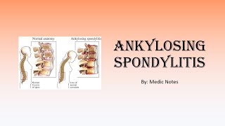 Ankylosing spondylitis  signs and symptoms Schober test Faber test imaging treatment [upl. by Ajnat]