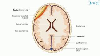 subdural empyema [upl. by Kinnie]