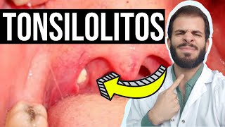 TONSILOLITOS👄💀 ¿Cómo ELIMINAR las bolitas blancas de la garganta [upl. by Beyer399]