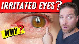 6 Top Causes Of IRRITATED EYES  Tips For Relief [upl. by Aholla]