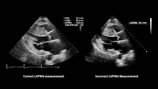 How to Measure Wall Thickness with Echocardiography [upl. by Dunn]