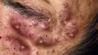 Big Cystic Acne Blackheads Extraction Blackheads amp Milia Whiteheads Removal Pimple Popping [upl. by Skeie967]