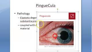 Ophthalmology 095 a PinGueCula What is Eye growth Yellow Degenerative Conjunctiva Reason Etiology [upl. by Anerahs]