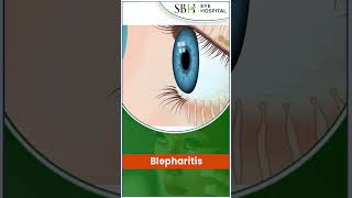 Blepharitis  SBH Hospital  What Is Blepharitis  Chhattisgarh [upl. by Sparks]