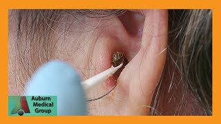 Chunky Earwax Removal  Auburn Medical Group [upl. by Sioled]