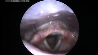 Videostroboscopy of a singer How does your voice work [upl. by Auqenat]