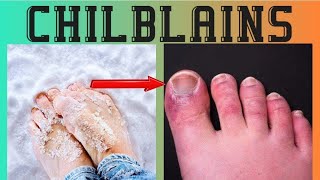 Chilblains causes symptoms treatment urduhindi [upl. by Assila]