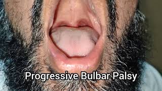 Tongue Fasciculations and Thenar Atrophy in Progressive Bulbar Palsy  Motor Neuron Disease [upl. by Xad]