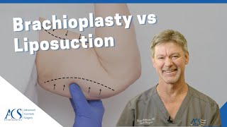 Brachioplasty Arm Lift Surgery Vs Liposuction Explained By Plastic Surgeon Dr Tom McFadden [upl. by Learsiy376]