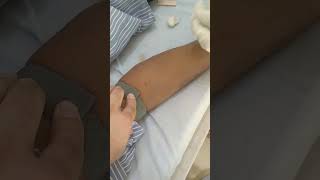 Intravenous canula insertion procedure [upl. by Birmingham]