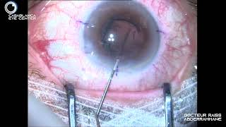 CATARACTE Rupture périphérique sans vitrectomie Implant sulcus  irrido L [upl. by Koss886]