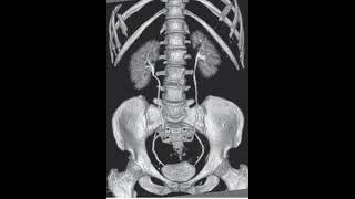 CT Urography  Post Processed urology ct radiology xray shorts video viralvideo trending [upl. by Yuht]