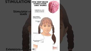 How Deep Brain Stimulation DBS Works medical animation 3d short [upl. by Yaffit2]