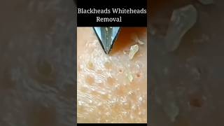 Whitehead Removal At Home blackheadswhiteheads skincare whiteheads song [upl. by Artinak]