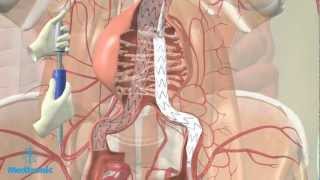 Operatie aneurysma van de buikslagader EVARprocedure [upl. by Eelrac]