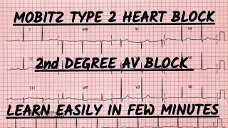 Second degree heart block ecg interpretation  Mobitz type 2 heart block ecg report kaise dekhe [upl. by Diao]