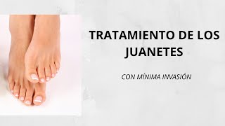 Tratamiento para los juanetes  Hallux Valgus [upl. by Nalad]