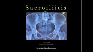 Sacroiliitis A common cause of back pain Part I [upl. by Clemens]