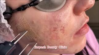 The best way to get beautiful even skin at Zarpash beauty clinic [upl. by Lindberg220]