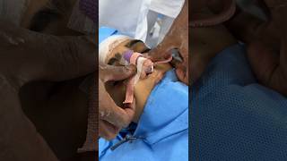 Nose Packing and Nasal splint after rhinoplasty [upl. by Arni]