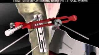 Tibial Tubercle Osteotomy using the T3 AMZ System [upl. by Einahpehs]