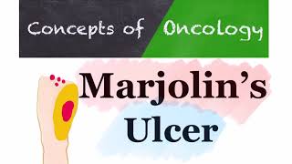 Marjolin’s Ulcer  Scar Cancer [upl. by Nauqal134]