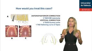 Miniscrew mechanics for molar distalization and incisor intrusion in a patient with a Class II brach [upl. by Adnihc821]