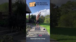 pectus excavatum exercises  concave chest [upl. by Elmore]